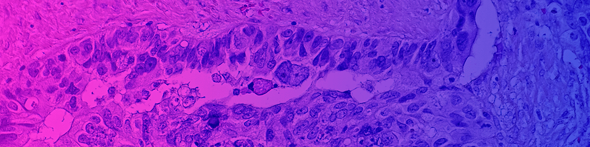 Cancer cross-section