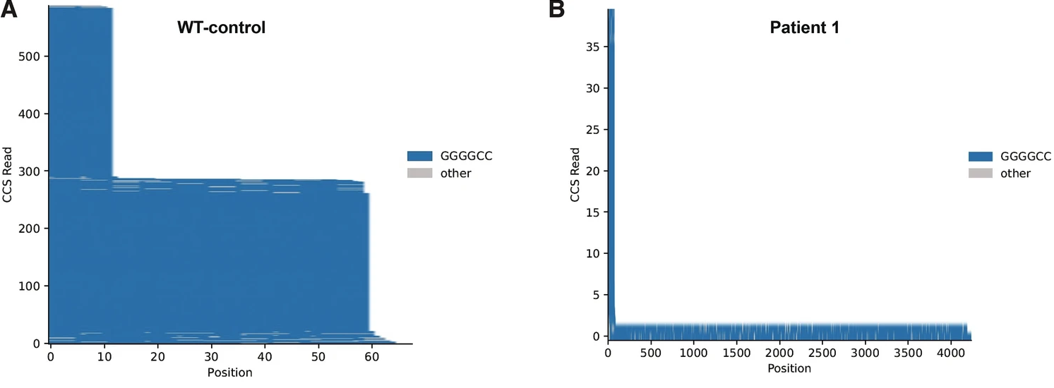 Figure 2 from Salomonsson, Maltos, et al. (2024). PacBio sequencing traces of the C9orf72 repeat region for patient and control cell lines showing the number of reads per repeat count. The WT line (A) has a bimodal repeat length distribution, while the patient lines show an expanded allele size (B).