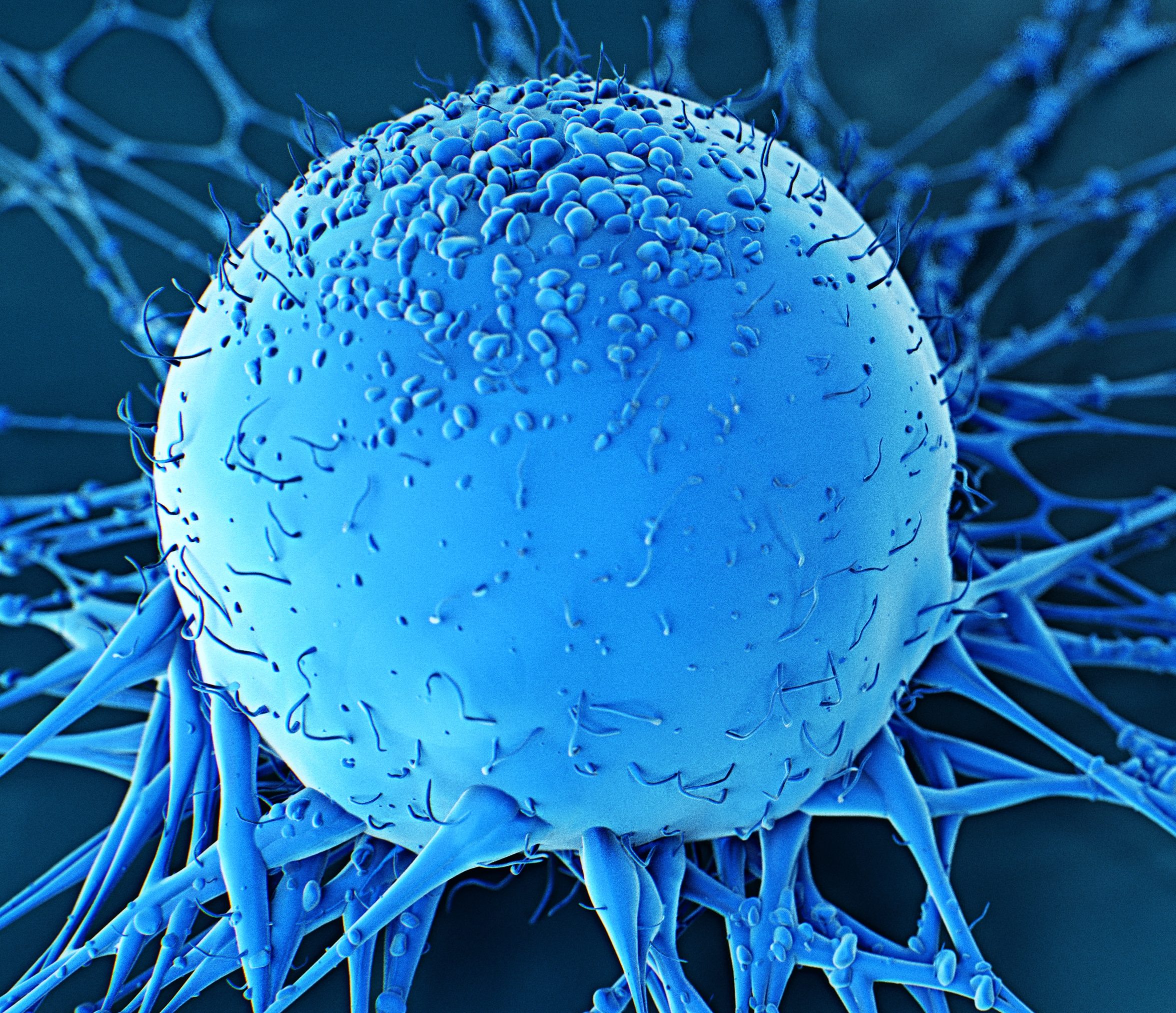 Human cancer cell
